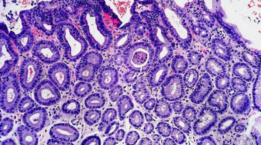Alveolar Soft Part Sarcoma Pathology Outlines