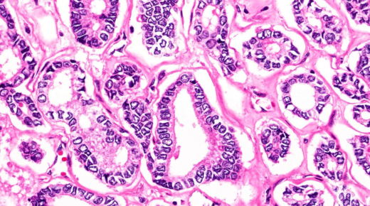 Thymic Carcinoma Pathology Outlines - A Comprehensive Overview