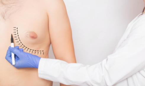 gynecomastia specialist in Coimbatore