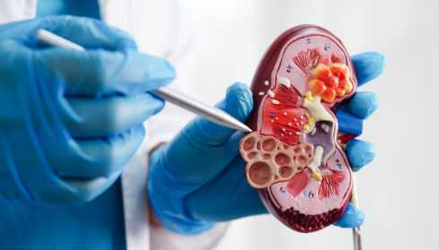 best kidney transplant hospital in Bangalore