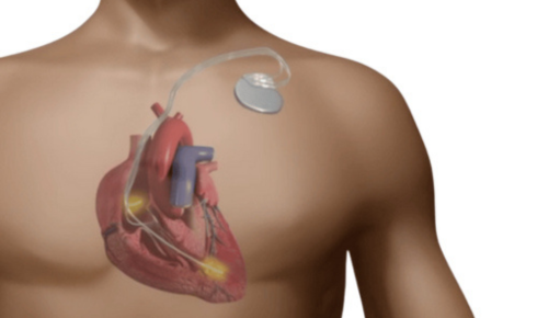 Pacemaker Surgery In Hyderabad